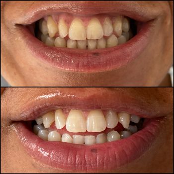 teeth-whitening-lausanne