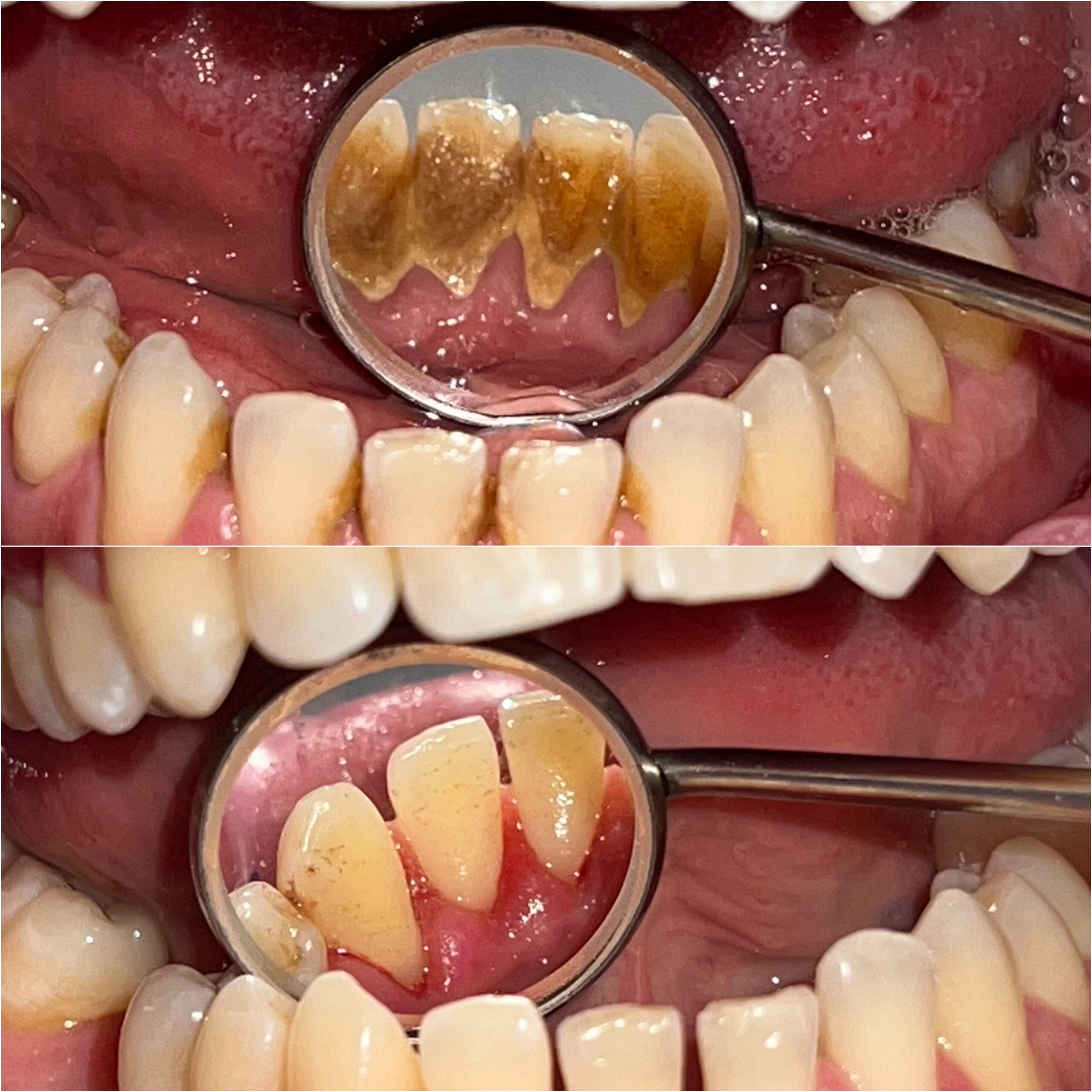 dental scaling before after