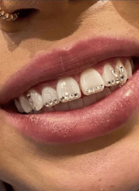 Brillantini Dentali - Whitening Artists