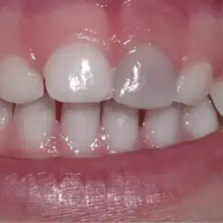 Black dental marks