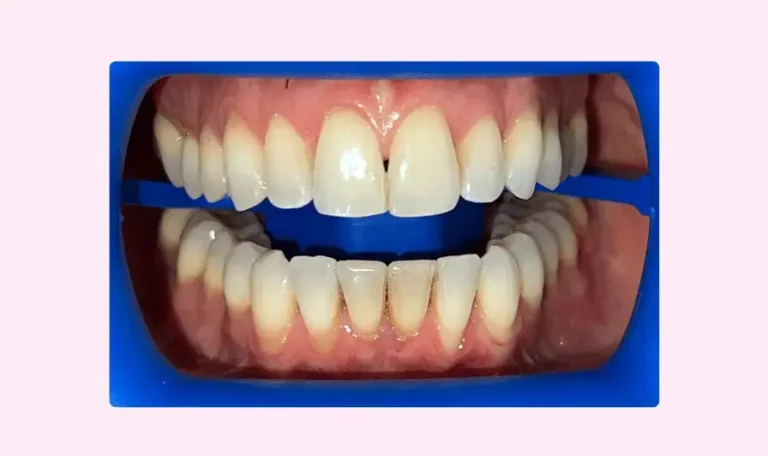 blachiment des dents procedure ecarteur dentaire