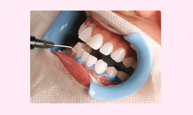 dental whitening geneva lausanne liquid dam