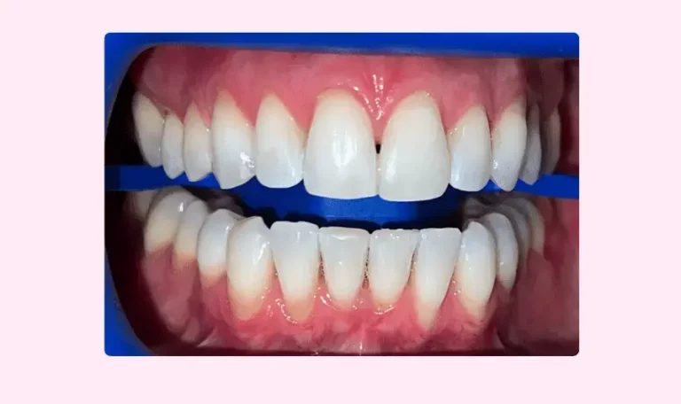 dental whitening lausanne geneva results