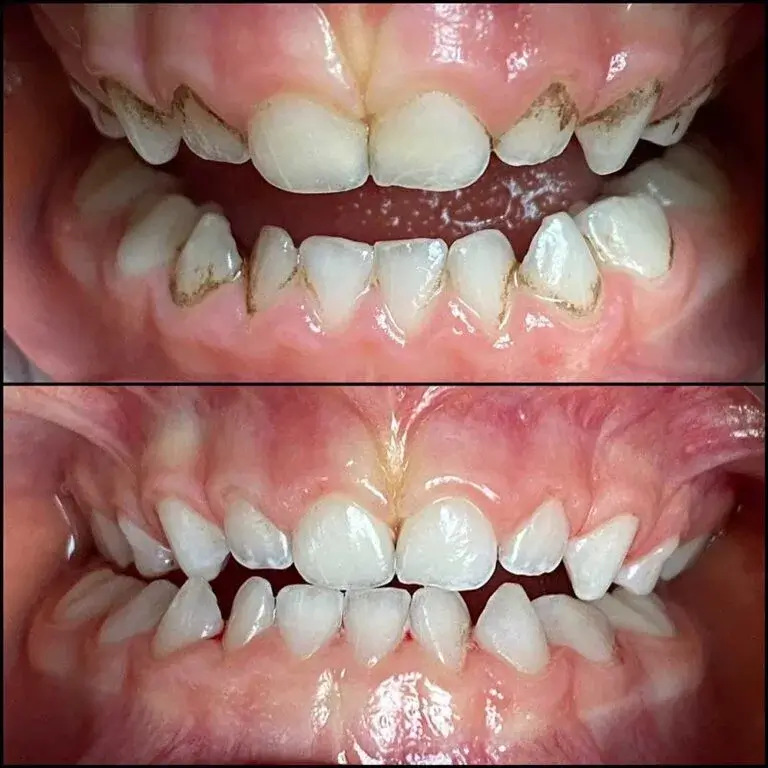 dental scaling before after