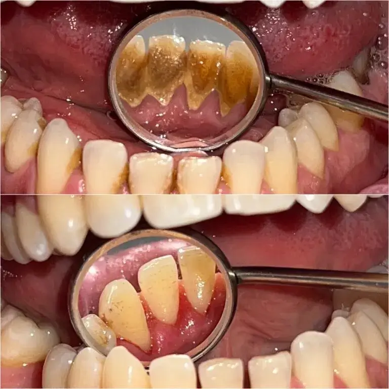 dental scaling children before after