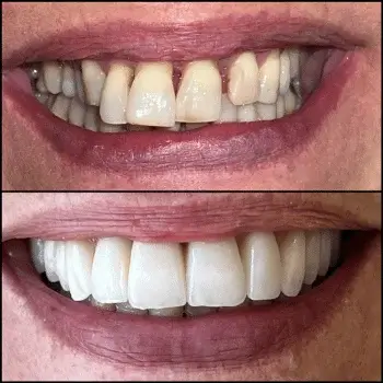 dental veeneers geneva before after