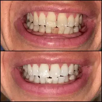 dental whitening geneva before after