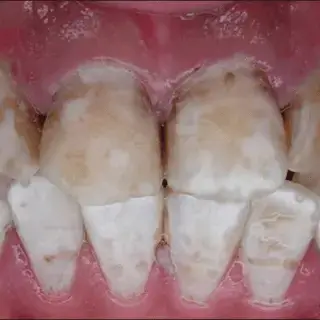 grey dental marks