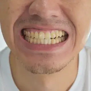 teeth yellow dental stains