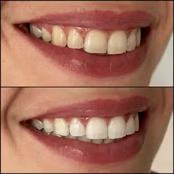 teeth whitening geneva before after