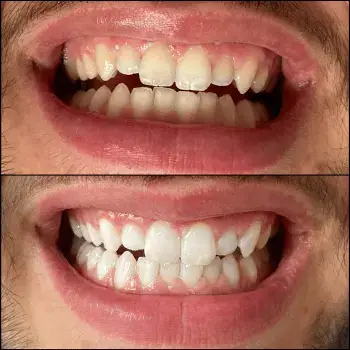 teeth whitening Geneva before after