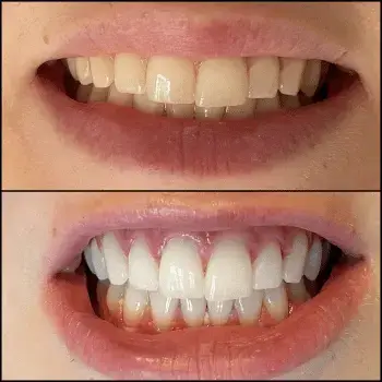 teeth whitening geneva before after photo