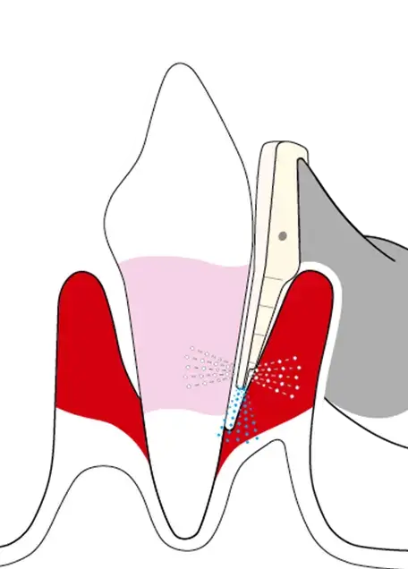 periodontitis deep scaling