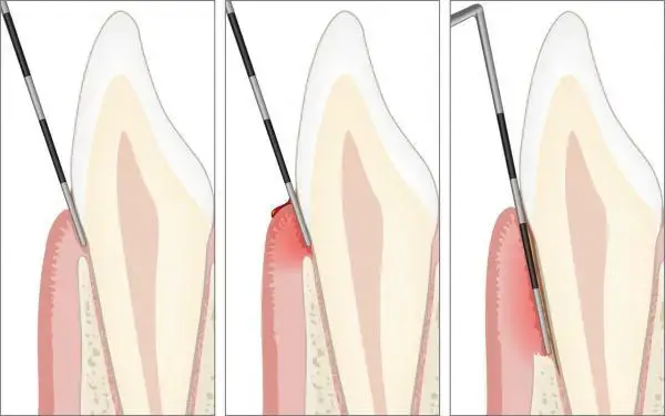 periodontal pocket