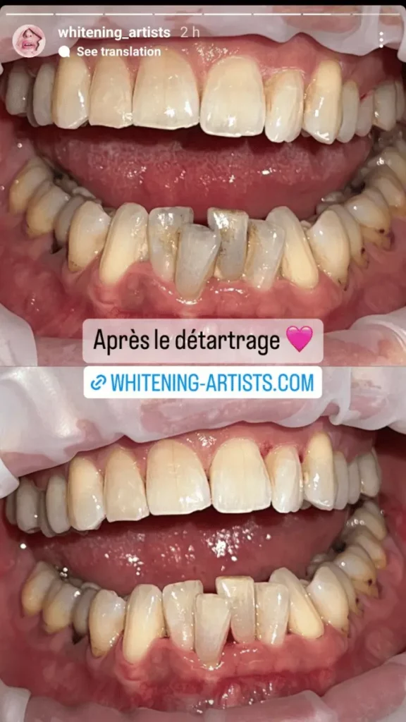 Détartrage Dentaire Après photo