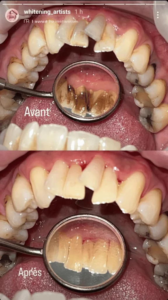 Détartrage Dentaire Avant Après Photo