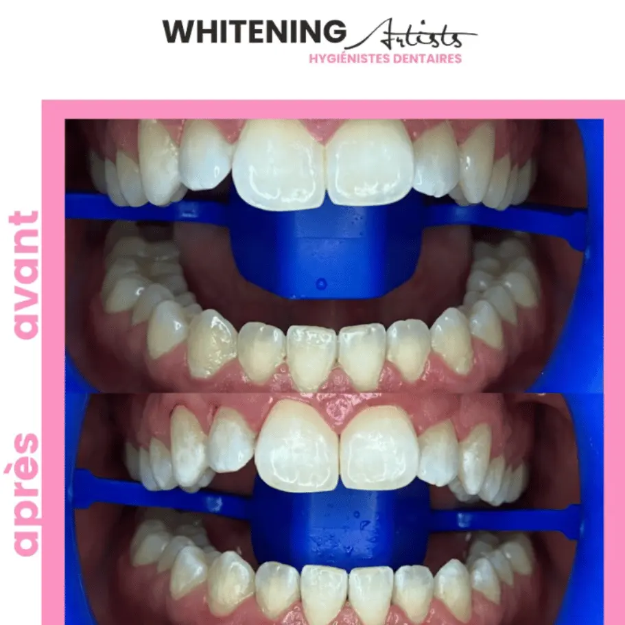 teeth whitening before after